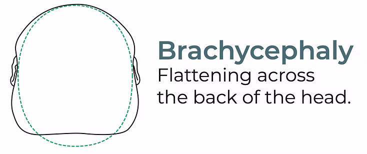 Brachycephaly