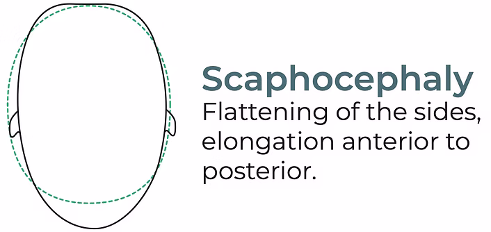 Scaphocephaly