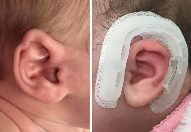 Ear molding example