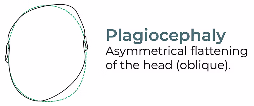 Plagiocephaly