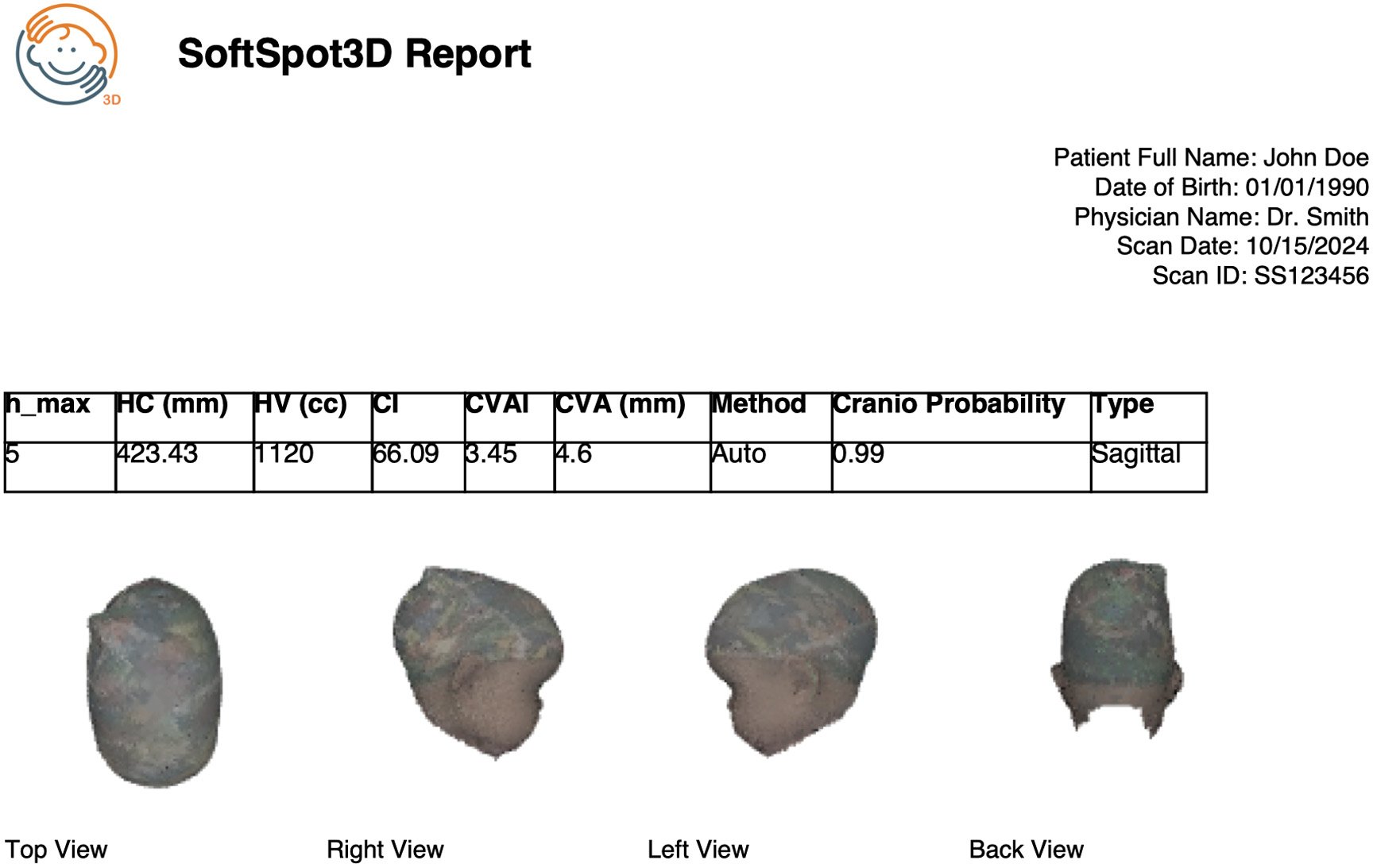 Example SoftSpot3D report: a header with placeholder patient details, a table of head circumference, head volume, cranial index, CVAI, CVA, craniosynostosis probability and type, and top, right, left and back views of the 3D head model.